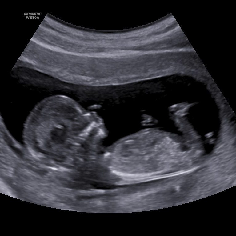 Schwangerschaftsbetreuung Ultraschallbild eines ungeborenen Kindes in der 20. Schwangerschaftswoche.